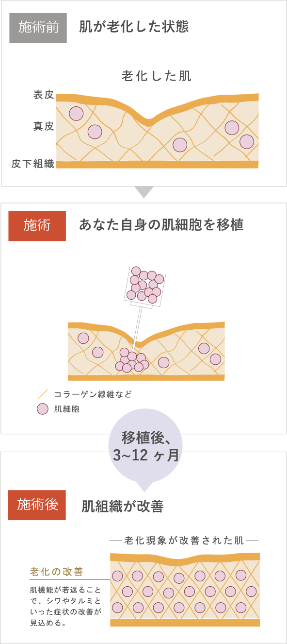 施術前・施術・施術後のイメージ図