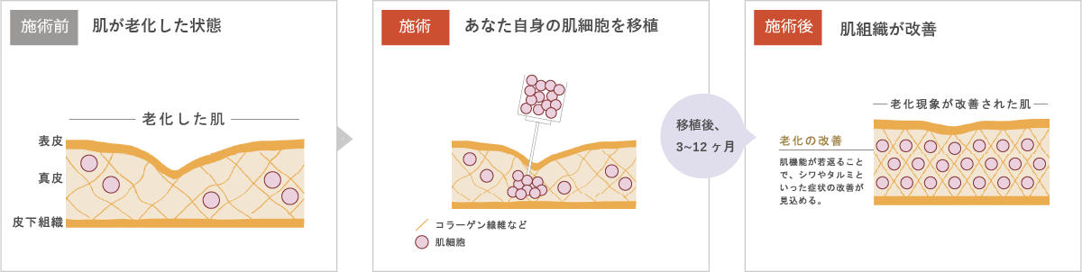 施術前・施術・施術後のイメージ図