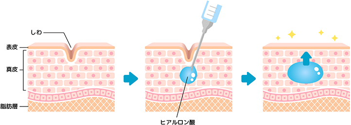 ヒアルロン酸注射とは What is Hyaluronic Acid Injection?