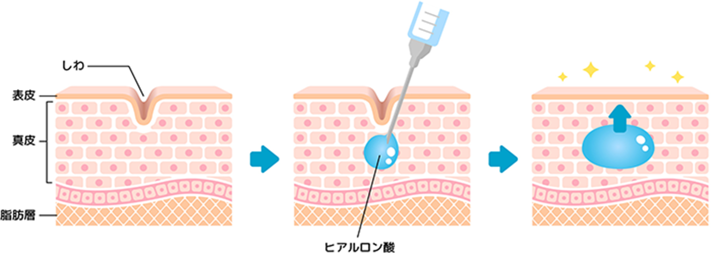 ヒアルロン酸注射とは What is Hyaluronic Acid Injection?