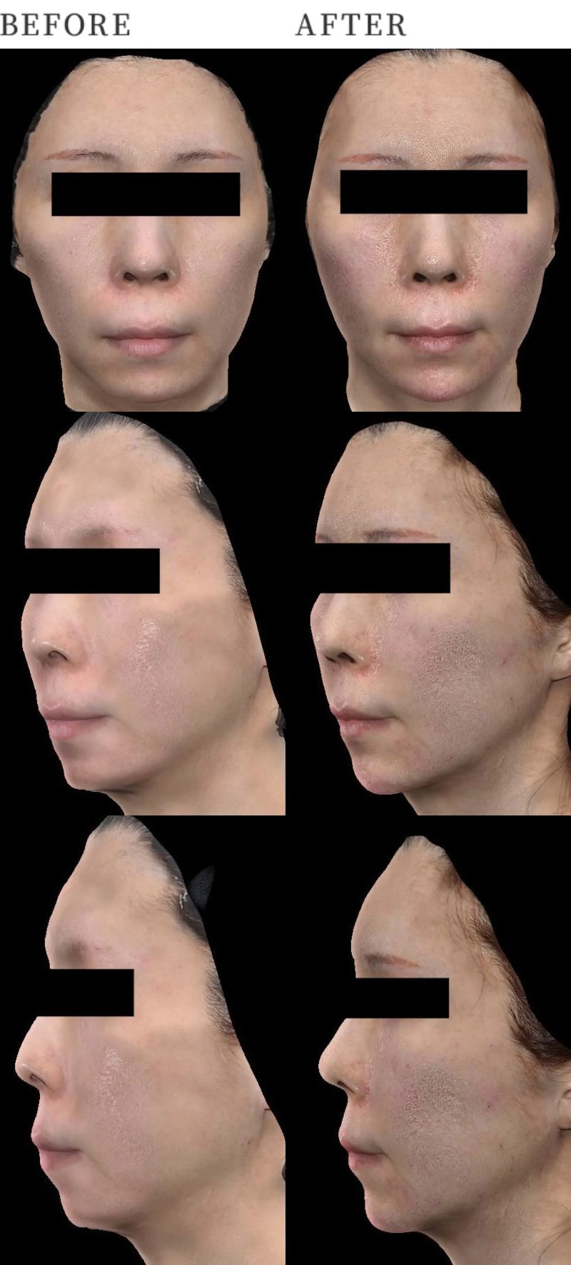 症例⑥:お顔のコケ、たるみ、顎の形