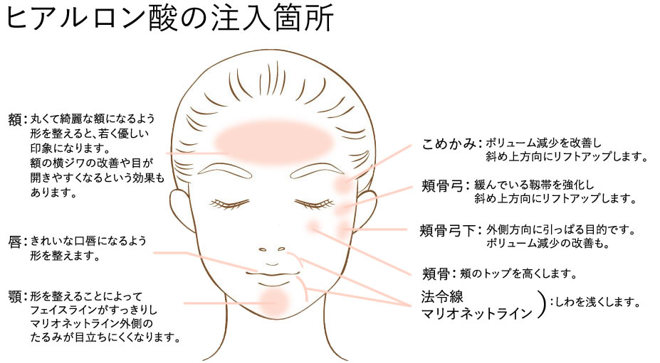 ヒアルロン酸の注入箇所