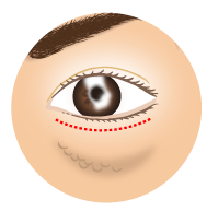下眼瞼脱脂術1