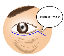下眼瞼切開術1