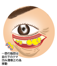 下眼瞼切開術2