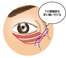 下眼瞼切開術3