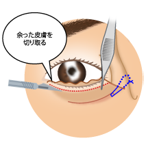 下眼瞼切開術4