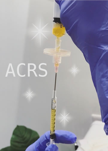 ACRS(自己血サイトカインリッチ血清)