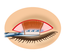 眼瞼下垂6