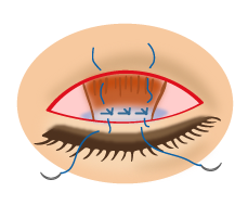 眼瞼下垂7