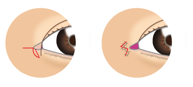 Z法で目頭をめいっぱい切開するやり方
