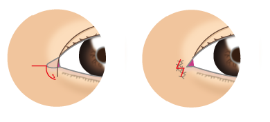 Z法で目頭を控えめに切開するやり方