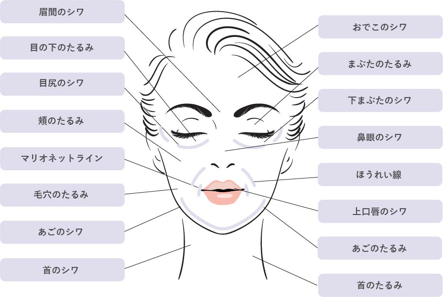 しわの種類の図