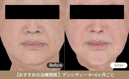 ボトックスのBeforeとAfterの画像