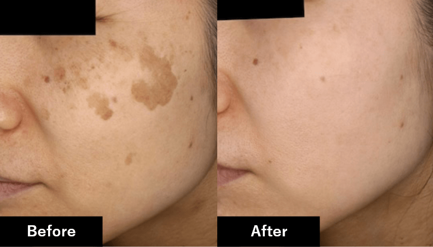 before after