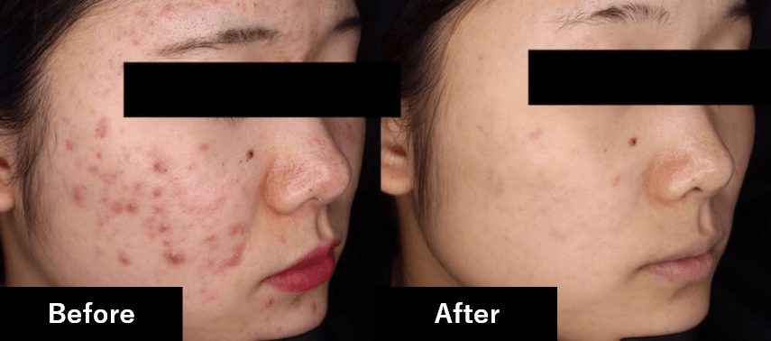 before after