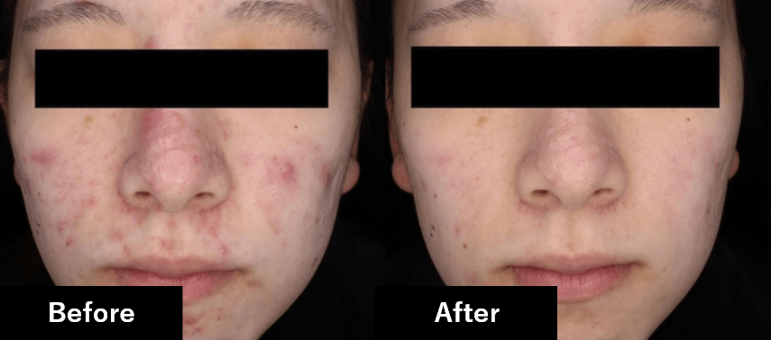 before after