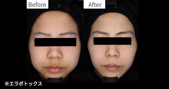 ボトックスのBeforeとAfterの画像