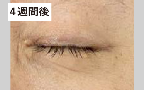 目元　４週間後