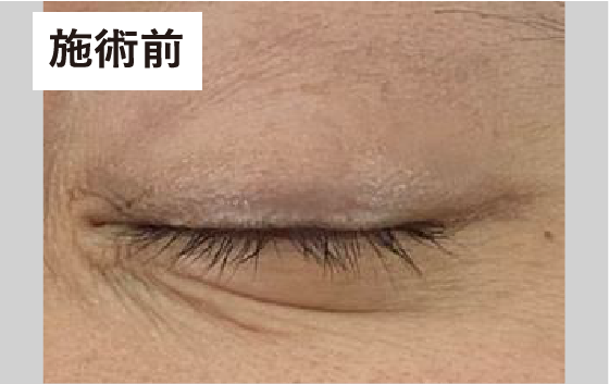 目元　施術前