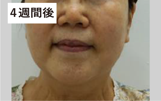 フェイスライン　４週間後