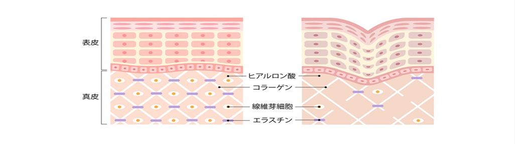 真⽪細胞外マトリックス（ECM）のリモデリング