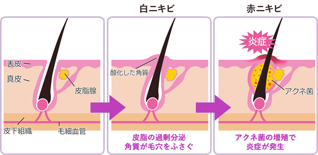 ニキビ びとう皮膚科 【ニキビ、皮膚科の選び方】いくらかかるの？費用と効果。