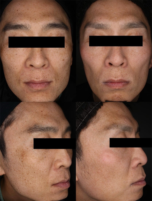 症例⑤：男性のシミ、くすみ