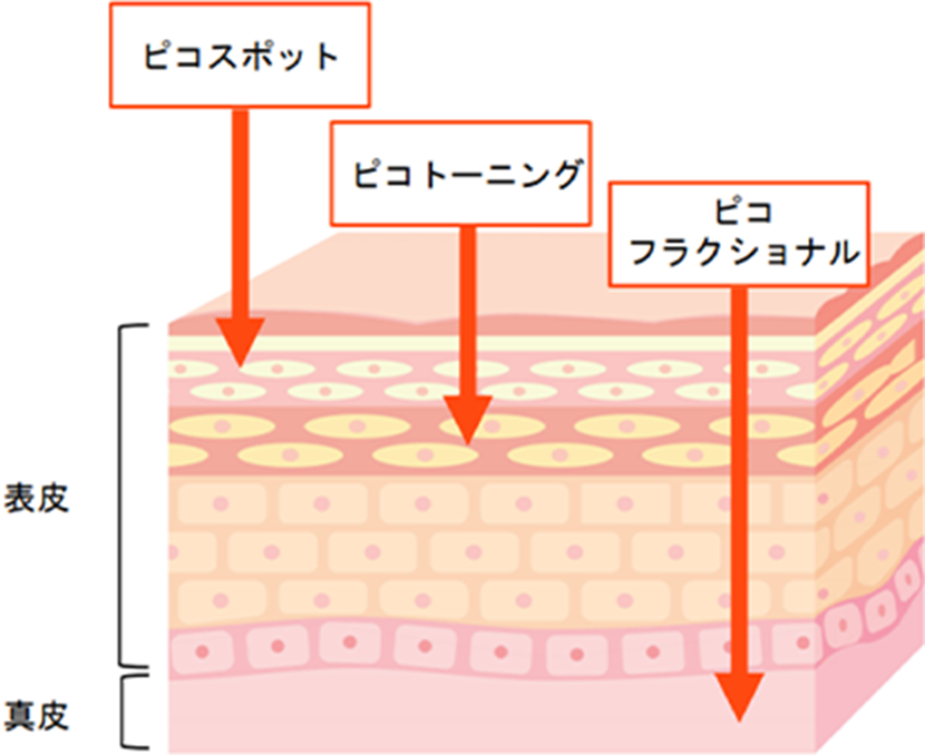 ピコレーザーの施術方法の違い