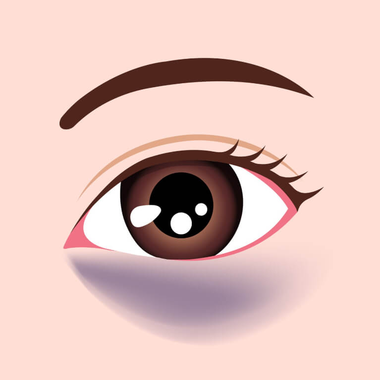 皮膚が薄く眼輪筋が透ける青クマ