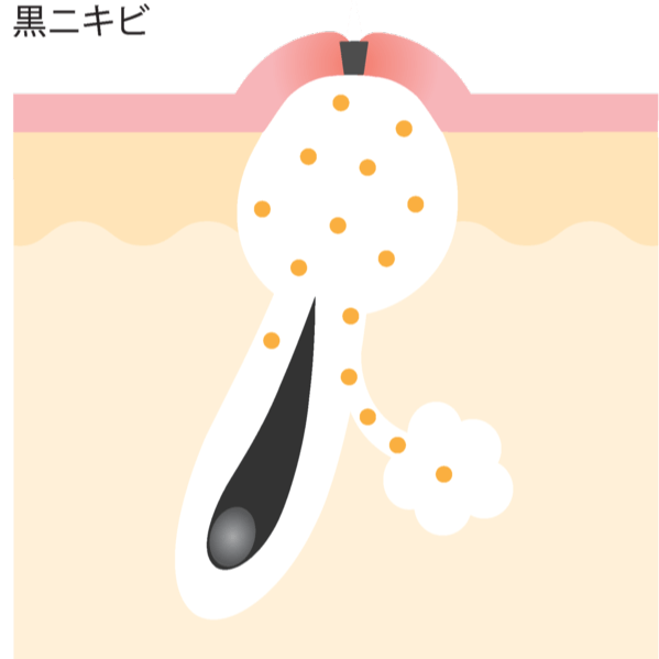 黒ニキビ