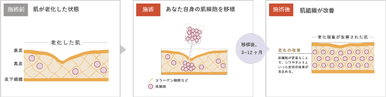 真皮線維芽細胞療法とは