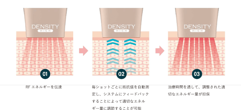 お一人おひとりに合わせた適切なエネルギー照射