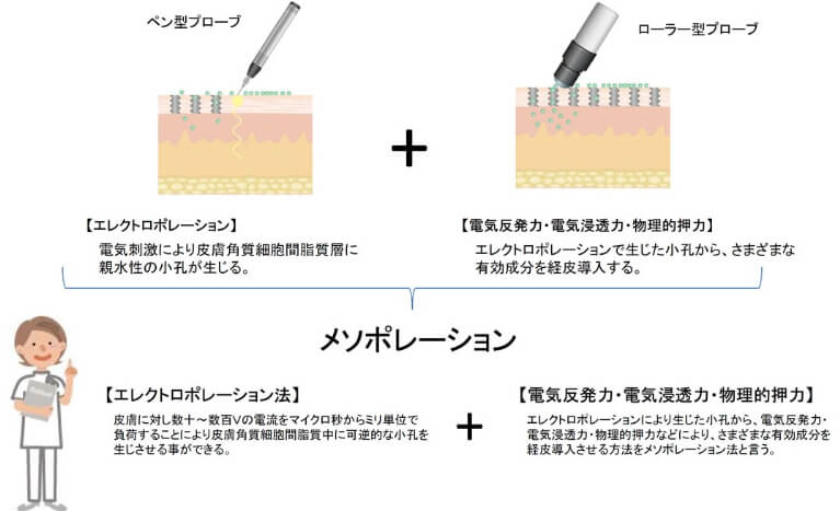 メソポレーションについて