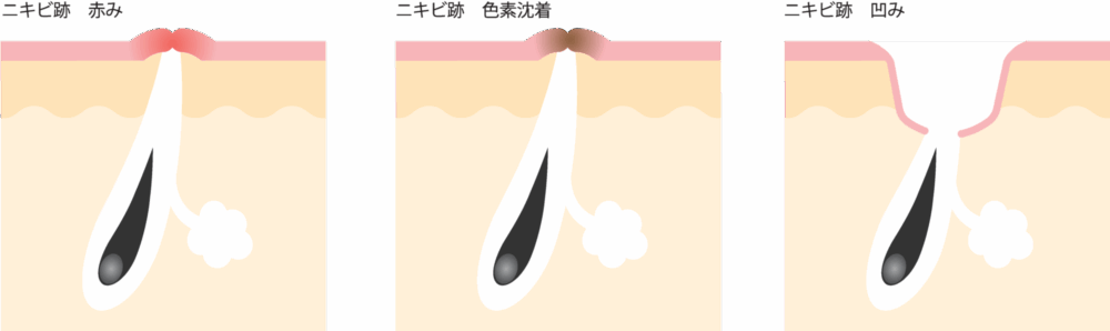 ニキビ跡
