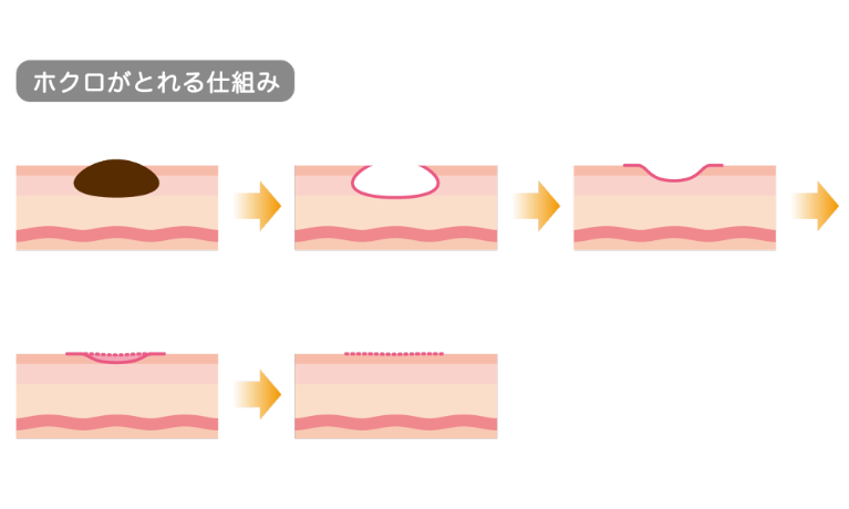炭酸ガスレーザーのメカニズム