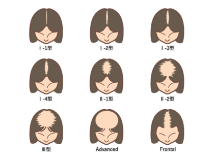 女性型脱毛症（FAGA）
