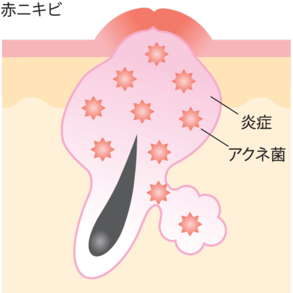 赤ニキビ
