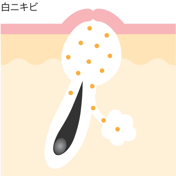 白ニキビ