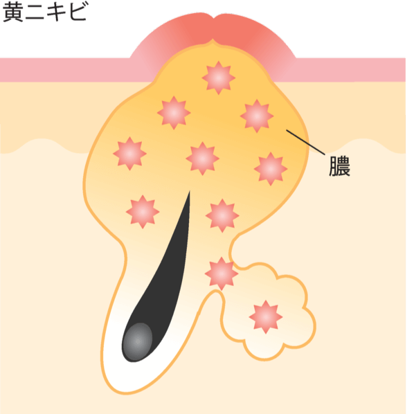 黄ニキビ