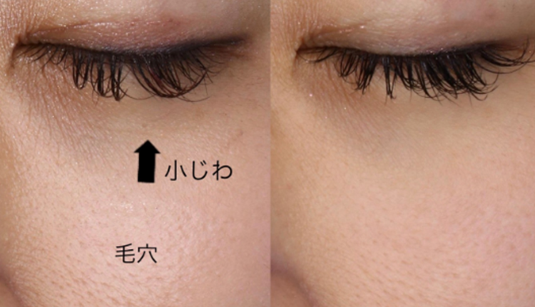 6 肌再生 ACRS（自己血サイトカインリッチ血清）