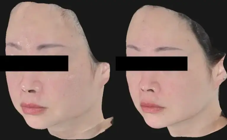 ヒアルロン酸 × ボトックス