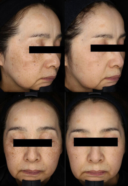 ピコシュアトーニング&フラクショナル